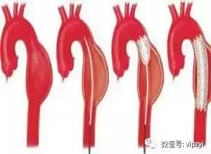 背痛一天,竟突然離世,醫生都措手不及,這病真的太兇險,千萬要注意了!