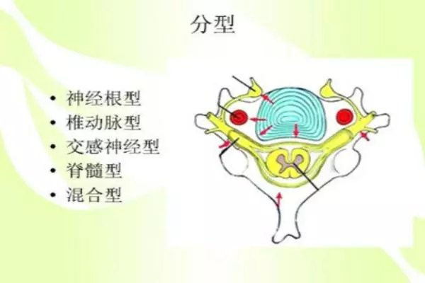 我的心慌原來是頸椎病造成的交感神經型頸椎病
