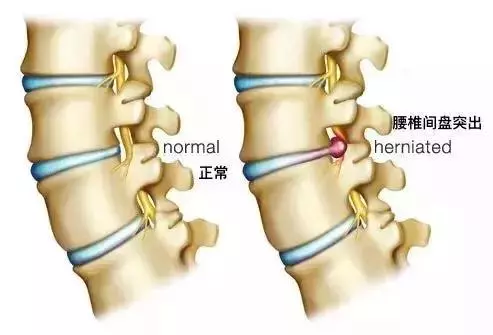 腰椎間盤突出不用慌,只要做到這一點,突出了也不腰疼!