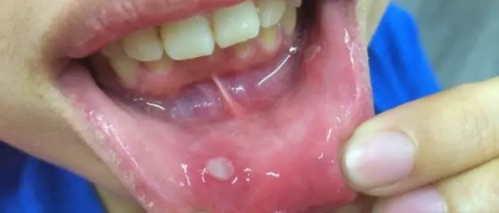 新年發熱氣??中醫師教你『6招快速降火』,讓你新年吃再多都不怕上火!?