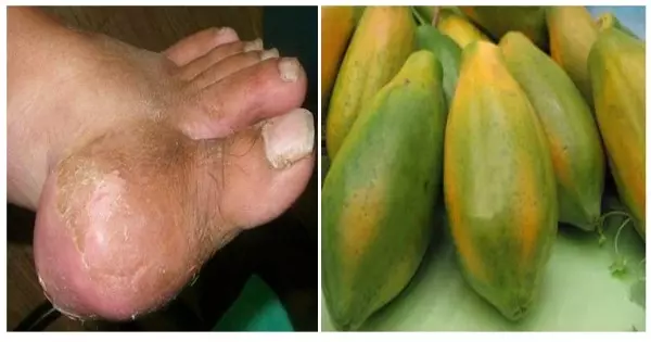 被痛風糾纏30年的婆婆, 一碗湯,讓她的痛風直接斷根,你的轉發可以幫助許多人。