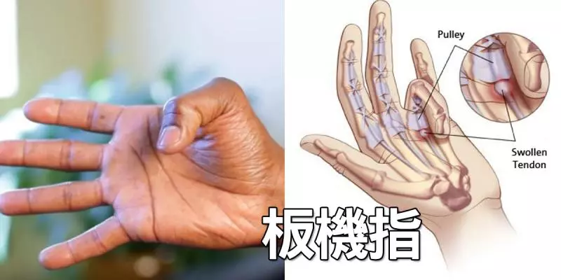 「板機指」發作手指僵硬動不了?兩分鐘「手指按摩」打通經脈,根治發炎免開刀!