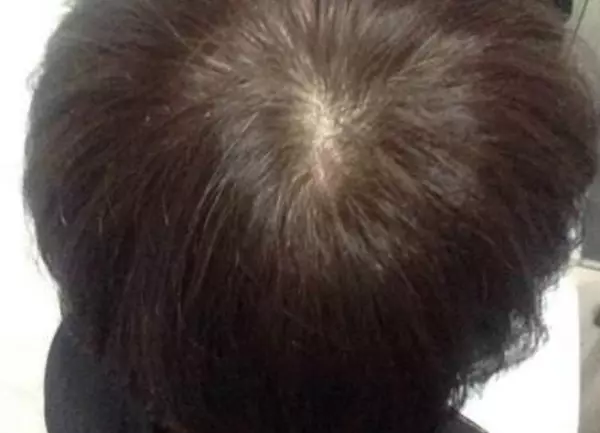 頭上有幾個漩,就代表你是什麼命!有三個漩的人註定不一般,太準了!