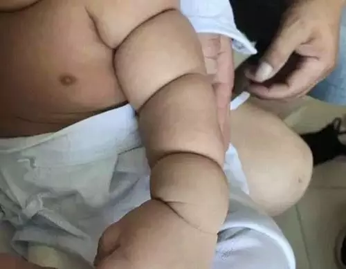 寶寶剛出生三個月,胖嘟嘟的,醫生卻說要做截肢手術