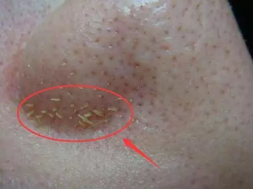 鼻子上難看的(小顆粒),教你三招強力去除,一周之後皮膚細膩似牛奶
