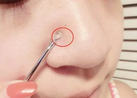 鼻子上難看的(小顆粒),教你三招強力去除,一周之後皮膚細膩似牛奶