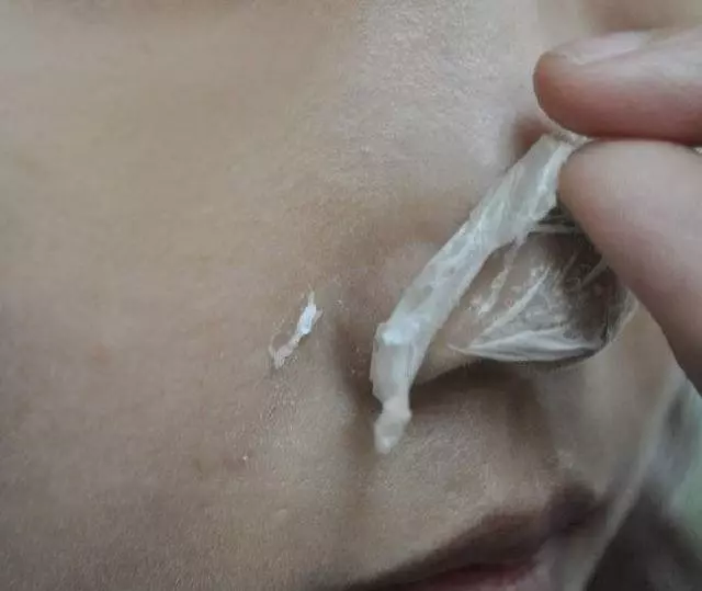 鼻子上難看的(小顆粒),教你三招強力去除,一周之後皮膚細膩似牛奶