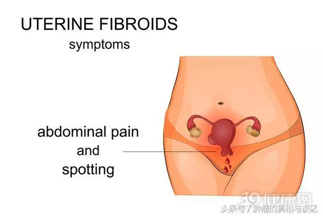 女人得了子宮肌瘤,身體會有5這大變化