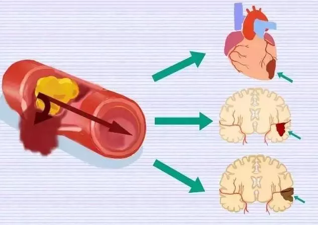 心腦血管病患者:最怕6種情況