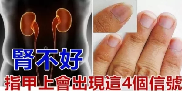 如果你「腎臟不好」你的指甲就會出現「這4個警告」很恐怖!不要不相信!