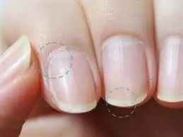 如果你「腎臟不好」你的指甲就會出現「這4個警告」很恐怖!不要不相信!
