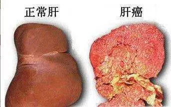 肝病化療也沒用?這3種東西常吃,修復肝細胞見效快,預防肝炎、肝硬化
