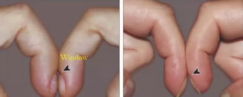 測血糖發現「手指不一樣」!「老菸槍」照X光已是肺癌末期,最終不幸病逝!醫師:「一個測指動作可自救~」