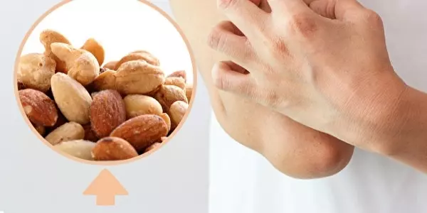 皮膚過敏發癢好不了?中醫師:先戒除「這食物」再說!