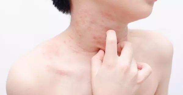 皮膚過敏發癢好不了?中醫師:先戒除「這食物」再說!