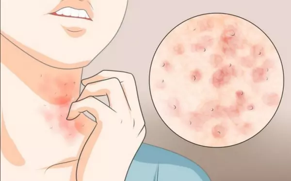 皮膚過敏發癢好不了?中醫師:先戒除「這食物」再說!
