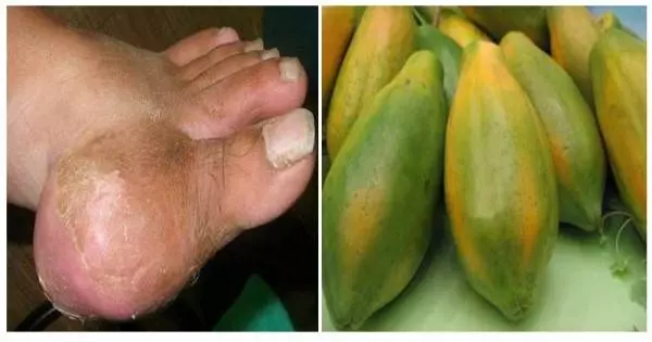 被痛風糾纏30年的婆婆, 一碗湯,讓她的痛風直接斷根,你的轉發可以幫助許多人。