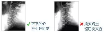 頸椎病傷在全身!最笨的辦法,不動脖子,兩招就搞定!