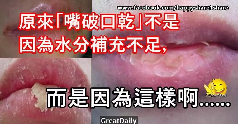 原來「嘴破口乾」不是因為水分補充不足,而是因為這樣啊!今天終於知道了!
