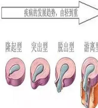 茴香加食鹽,堅持10天,腰腿痛不見了,連腰突、坐骨痛也消了