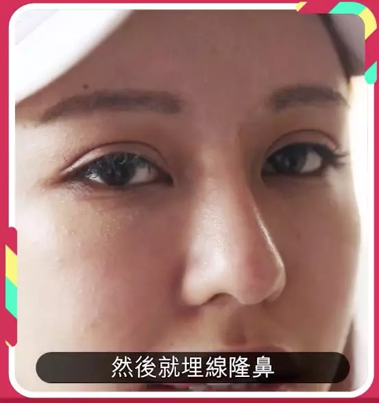 女子為男友整容30次!男友洗腦式說教太恐怖,酸完臉酸她胸小!
