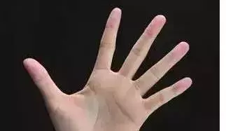 腦血栓自救保命方法,只需刮這條「青筋」