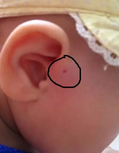注意!你家寶寶耳朵上有這種小孔嗎?如果有,就要小心了!!!