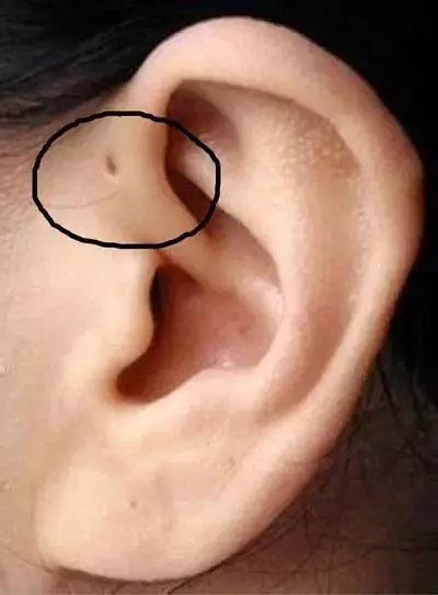 注意!你家寶寶耳朵上有這種小孔嗎?如果有,就要小心了!!!