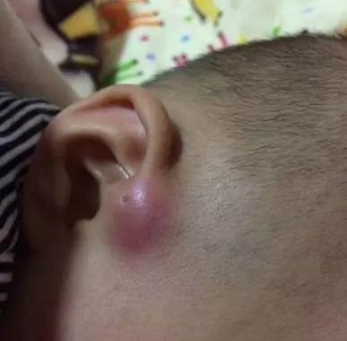 注意!你家寶寶耳朵上有這種小孔嗎?如果有,就要小心了!!!