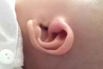 注意!你家寶寶耳朵上有這種小孔嗎?如果有,就要小心了!!!