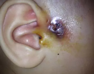 注意!你家寶寶耳朵上有這種小孔嗎?如果有,就要小心了!!!