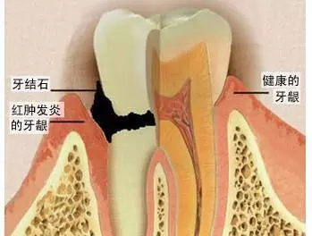 到底要不要定期「洗牙」?專家一句話解開你多年的疑惑!