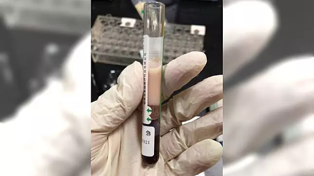 恐怖!整天看電視配瓜子 女子血脂爆表抽出「牛奶血」