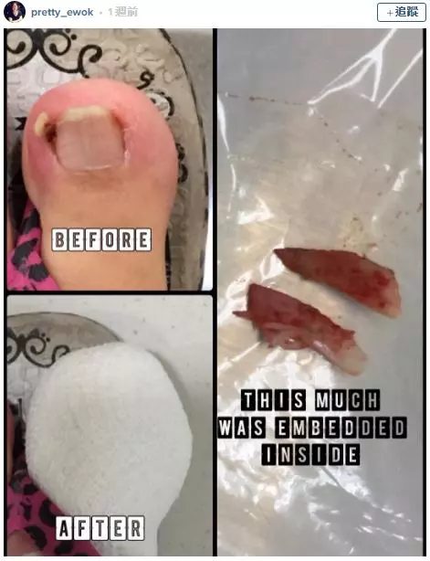 17個會讓人覺得超噁爛的「腳指甲知識」 人類的腳指甲其實是爪子
