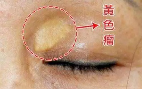 眼睛出現這種改變,是中風的前兆!千萬別忽視!