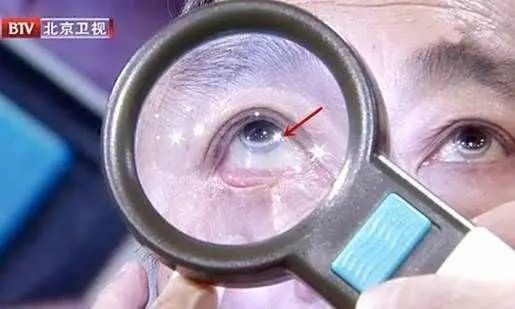 眼睛出現這種改變,是中風的前兆!千萬別忽視!