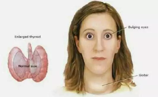 眼睛出現這種改變,是中風的前兆!千萬別忽視!