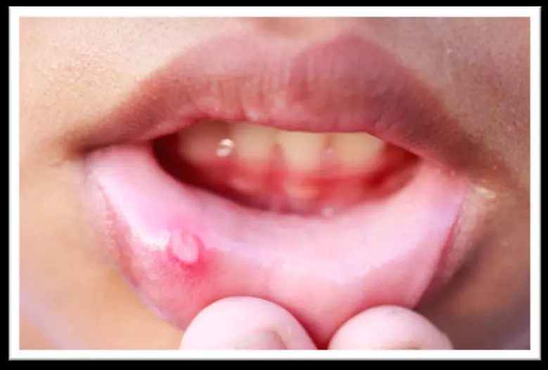 嘴唇生 Ulcer 很難好?教你幾招快速治療「口腔潰瘍」方法!超有效!