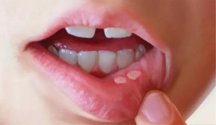 嘴唇生 Ulcer 很難好?教你幾招快速治療「口腔潰瘍」方法!超有效!