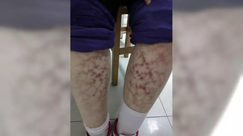 嚇人!愛窩電暖爐旁 她小腿長滿「網狀紅斑」
