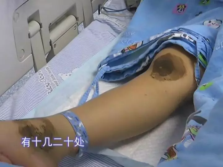 「爸爸,我不治了,給我買雙新鞋和一身新衣服就好。」 8歲女童被馬蜂群蜇,求家人放棄!…