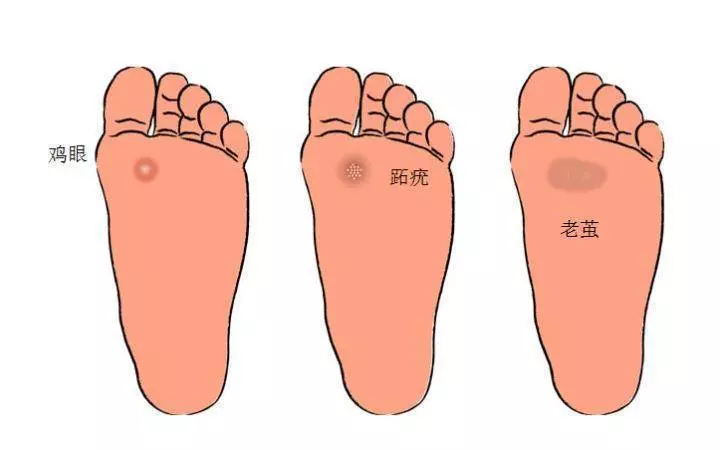 雞眼怎麼根治?這個偏方很有效