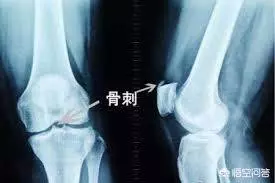 母親膝蓋骨質增生,走路時刺辣辣的痛,我從一女老中醫處得一秘方,3日痛覺全無,5日根治!