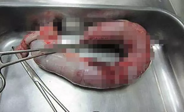 腫瘤專家:大便後出現三種情況,是「腸裡面的壞細胞」上身了,千萬注意