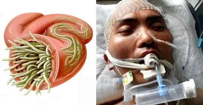 深圳男子被「吃腦蟲」入侵去世,現在就來盤點哪些「食物含有寄生蟲」!