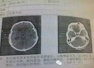 深圳男子被「吃腦蟲」入侵去世,現在就來盤點哪些「食物含有寄生蟲」!