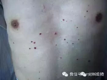 身上黑痣、白斑、血痣原來是這麼來的!!看完才知道自己身體有多髒!!