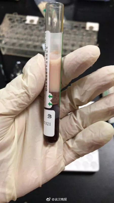 過年天天嗑瓜子!女子腹痛,到醫院檢查竟抽出「牛奶血」!網友驚:「嚇得我瓜子都掉了!」