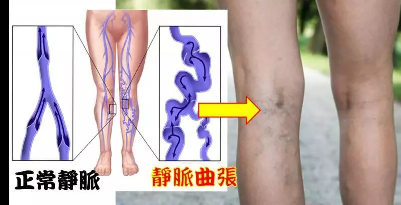 你是否因久坐、久坐,腿部血液循環差?「8種天然食物」對抗靜脈曲張,幫助血管恢復健康!!