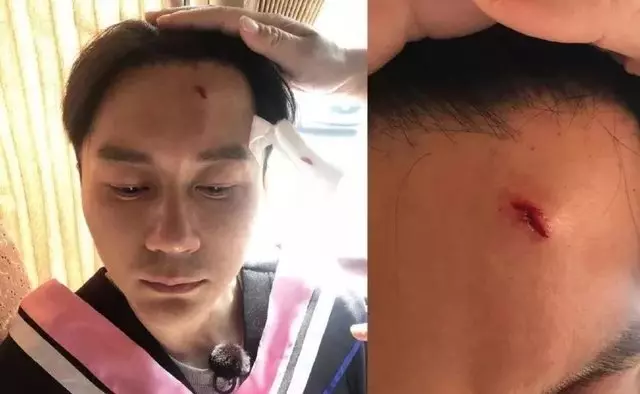 綜藝節目頻出意外!李晨縫了22針,而他卻昏迷6天不幸死亡!